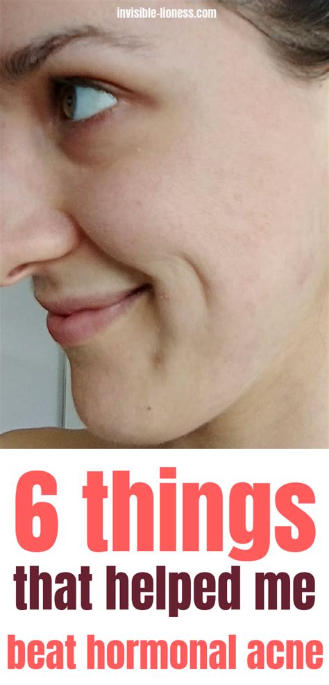 I Beat Hormonal Acne My 6 Powerful Little Secrets Hormonal Acne