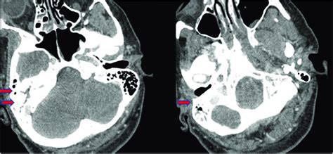 Ct Scan Of Head Near Complete Opacification Of The Right Mastoid Air