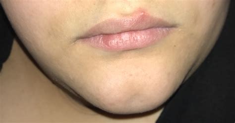 Can Anyone Tell Me What This Bump On My Lip Is Sexual Health