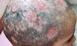 The most common ages for this type of scalp infection are between the ages of 4 and 14. Types Of Ringworm Causes Symptoms And Treatment | Skin And ...