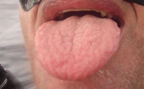 Strange Signs You Re Having An Allergic Reaction Live Science