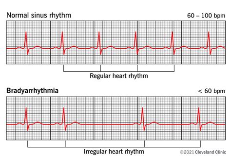 Bradyarrhythmia Symptoms Causes And Treatment