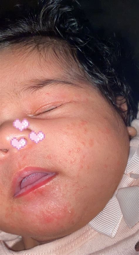Help Please Weird Rash On Baby Face Babycenter