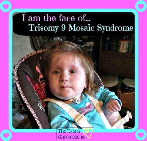 The Extra Chromosome Trisomy 9 Mosaic