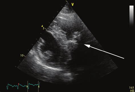 Echodense Mass Within The Right Ventricular Outflow Tract With Acoustic