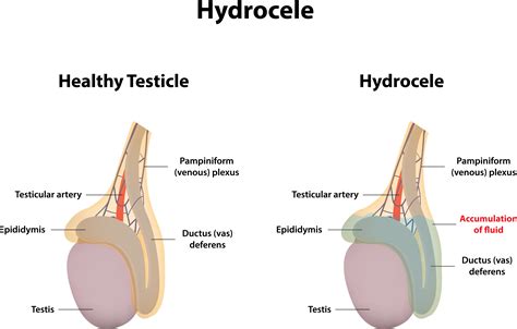 ¿testículos Inflamados Conoce Más Sobre La Hidrocele Estilo De Vida