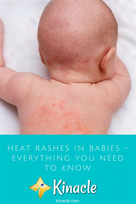 Heat Rashes In Babies Everything You Need To Know Heat Rash Baby