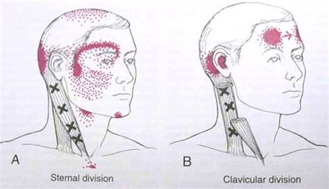 Sternocleidomastoid Trigger Point Diagram The Most Common Cause Of
