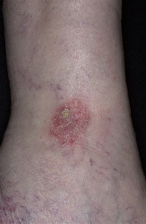 Stasis Dermatitis Pictures 174 Photos And Images