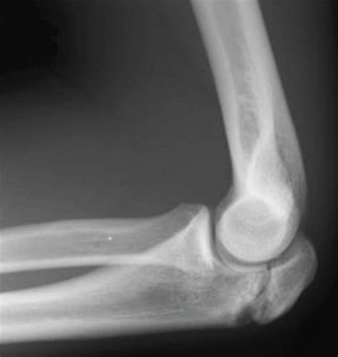 Radiographs Of The Elbows Of A 15 Year Old Male Patient Patient 1