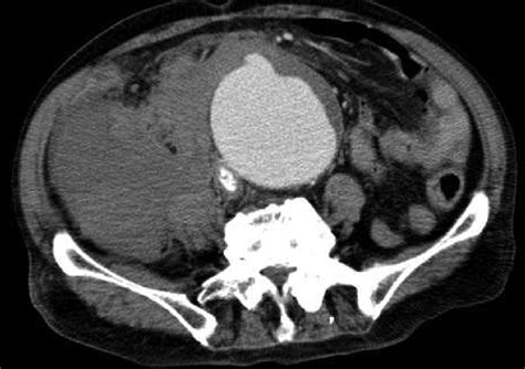 Contrast Enhanced Computed Tomography Ct Scan Showing An 80 × 85 Mm