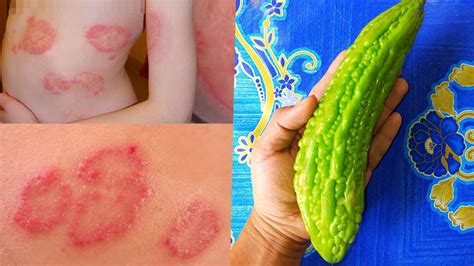 How To Get Rid Of Ringworm Fast At Home Treatment For Ringworm
