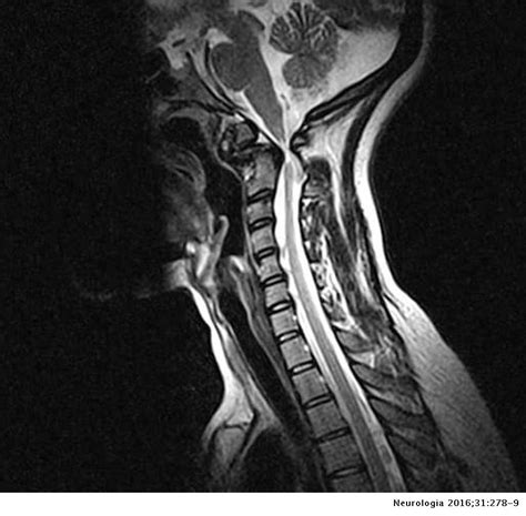 Cervical Myelopathy As The Initial Manifestation Of Os Odontoideum