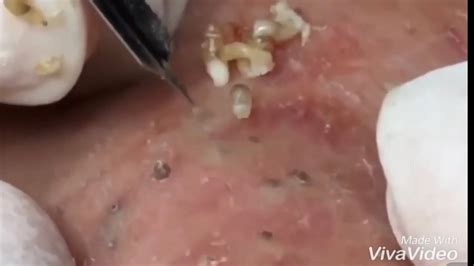 Pimple Popping 2020 Video 33 Blackhead Removal Whitehead Removal
