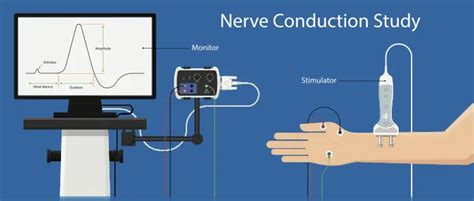 Nerve Conduction Velocity Test Ncv