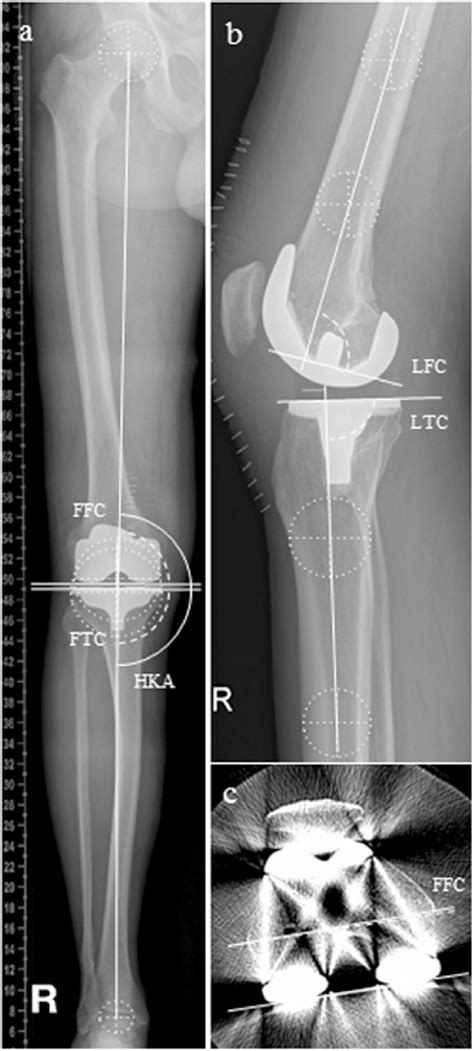 Postoperative Radiographs A B And Ct Scan C Of A Right Leg And
