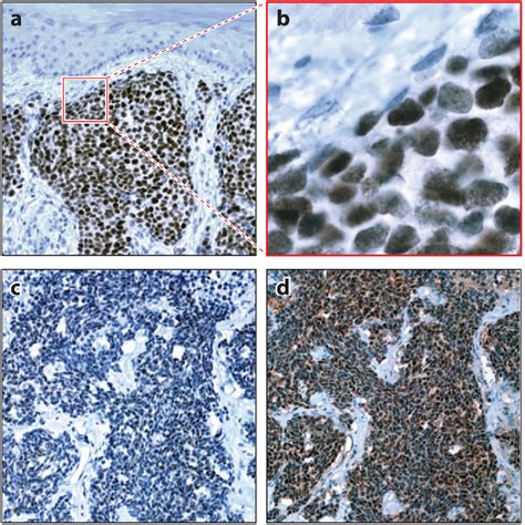 Figure 7 From Merkel Cell Carcinoma A Virus Induced Human Cancer