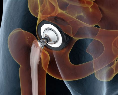 Anterior hip Replacement - Delray Orthocenter