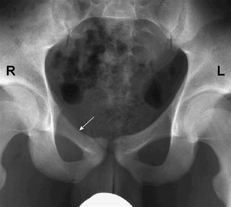 Uncommon Aneurysmal Bone Cyst Radiographic And Mri Findings Ajr