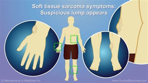 Soft Tissue Sarcoma Usually Appears As A Painless Lump Under The Skin
