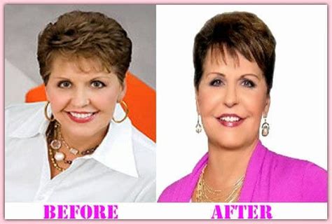 Joyce Meyer Before And After Plastic Surgery