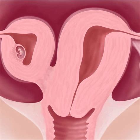 A D Ultrasound Showing Transverse View Of Unicornuate Uterus On Left