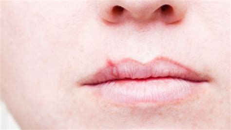 Cold Sore Causes Symptoms And Treatment Md