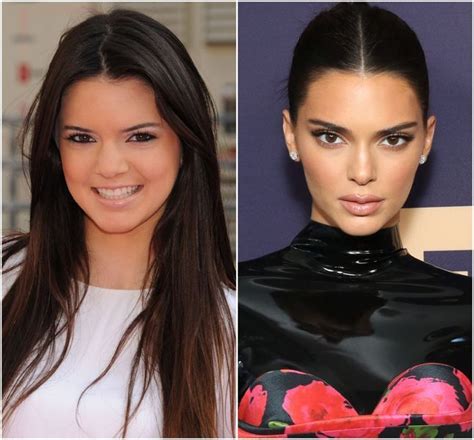 Heeft Kendall Jenner Plastische Chirurgie Ondergaan Evertyhing Shes Said Mode Schoonheid