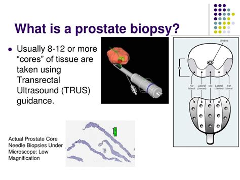 Ppt Prostate Needle Biopsy The Pitfalls And The Role Of The Pathologist Patient Track