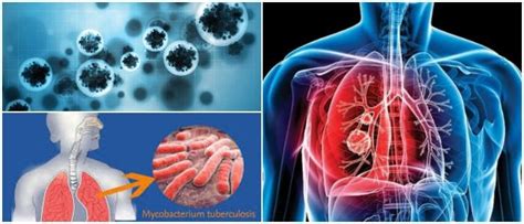 Tuberculosis Causas Factores De Riesgo Síntomas Diagnóstico
