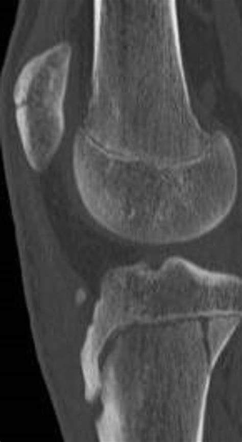 Imaging Review Of Adolescent Tibial Tuberosity Fractures