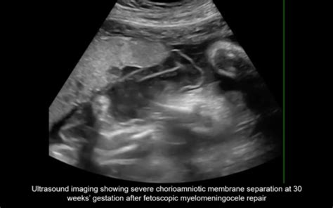 Uog Video Clip Chorioamniotic Membrane Separation Following Fetal