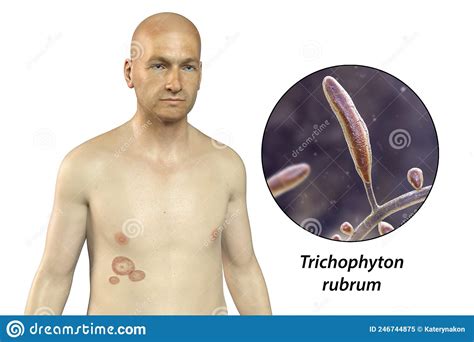 Fungal Infection On A Man S Body Tinea Corporis 3d Illustration Stock