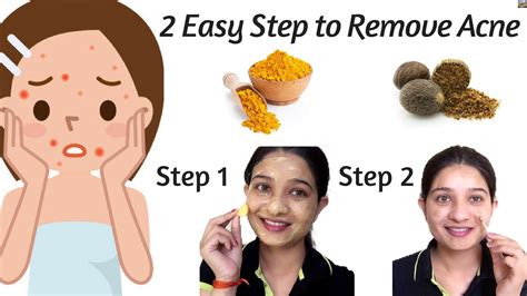 2 Step To Remove Acne How To Get Rid Of Acne Fast Remove Pimple