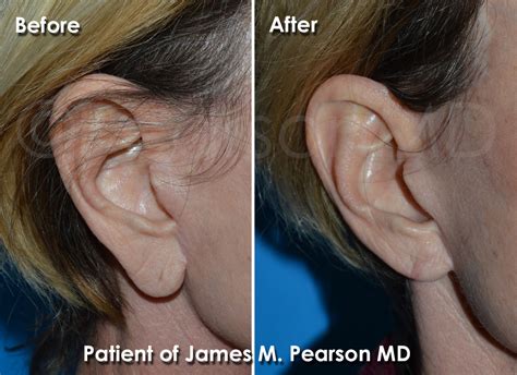 Earlobe Plastic Surgery Photos Before And After Dr James Pearson Facial Plastic Surgery