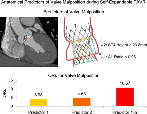 Frontiers Anatomical Predictors Of Valve Malposition During Self