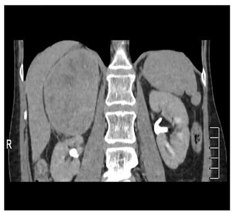 Management Of Retroperitoneal Schwannoma Case Reports And Review Of