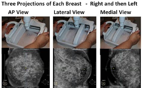 The Characteristics Of 3 D Automated Breast Ultrasound Abus