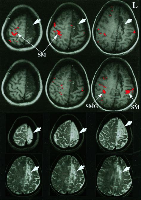 Pilot Study Of Functional Mri To Assess Cerebral Activation Of Motor