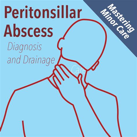 Mastering Minor Care Peritonsillar Abscess — Taming The Sru