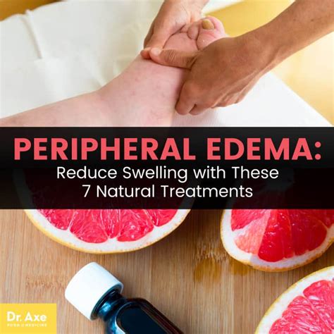 Peripheral Edema 7 Natural Treatments To Reduce Swelling Get