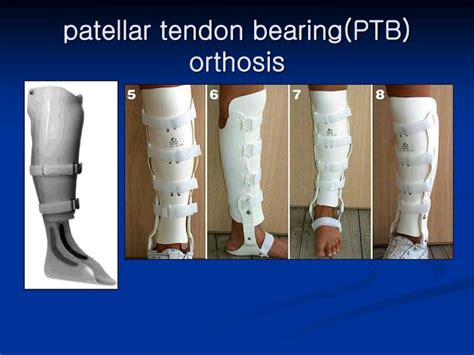 Important notes about your ptb orthosis a ptb orthosis is a very specialized device. PPT - Amputation PowerPoint Presentation - ID:6099256