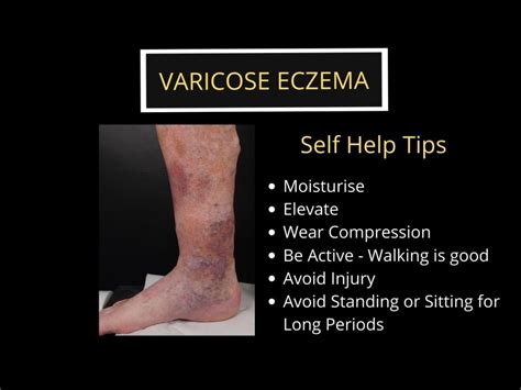 Is Walking Good For Varicose Eczema The Veincare Centre