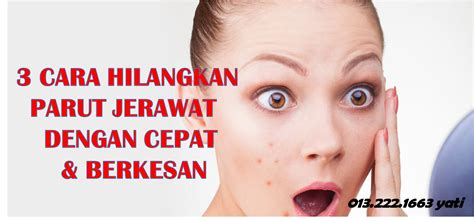 4 cara hilangkan parut jerawat secara semulajadi. Vitamin Yati: 3 Cara Hilangkan Parut Jerawat Dengan Cepat ...