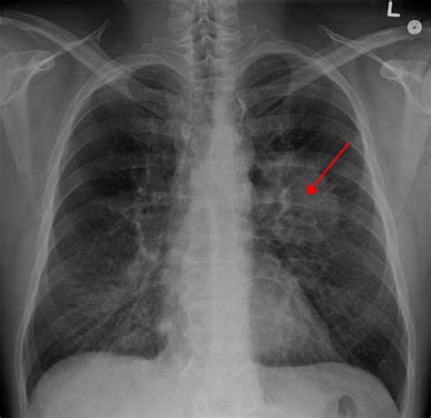 For example, imaging tests can show if the cancer has spread. Asbestosis vs. Mesothelioma: 5 Facts You Need to Know