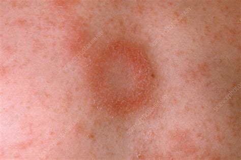 Pityriasis Rosea Stock Image C Science Photo L Vrogue Co