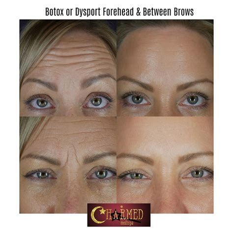 What To Expect At Your First Botox Treatment Charmed Medispa