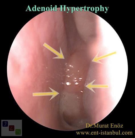 Enlarged Adenoids May Cause Chronic Sinus And Middle Ear Infections In