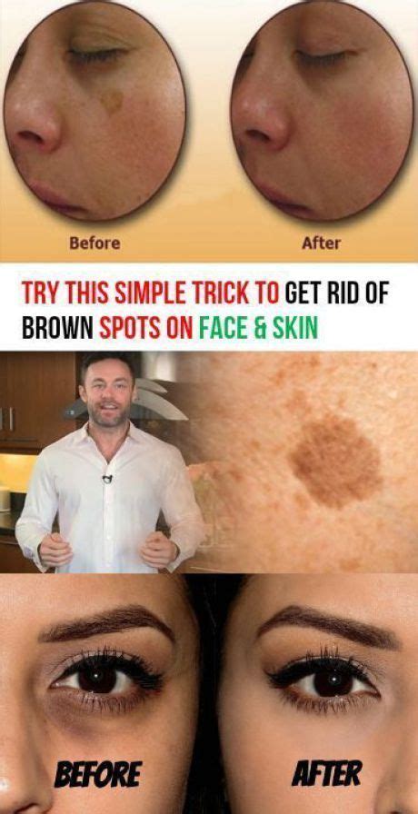 Dark Spots How To Get Rid Of Them Brown Spots On Face Spots On Face