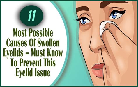 11 Most Possible Causes Of Swollen Eyelids Must Know To Prevent This